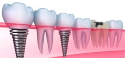 Dental Implant Drawings'