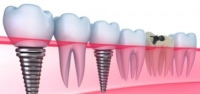 Dental Implant Drawings
