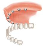 Implant Supported Dentures'