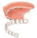 Implant Supported Dentures