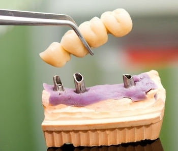 Implant Dentistry'
