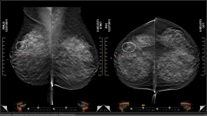 Mammography Visualization