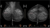 Mammography Visualization'