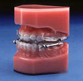 Oral Appliance'