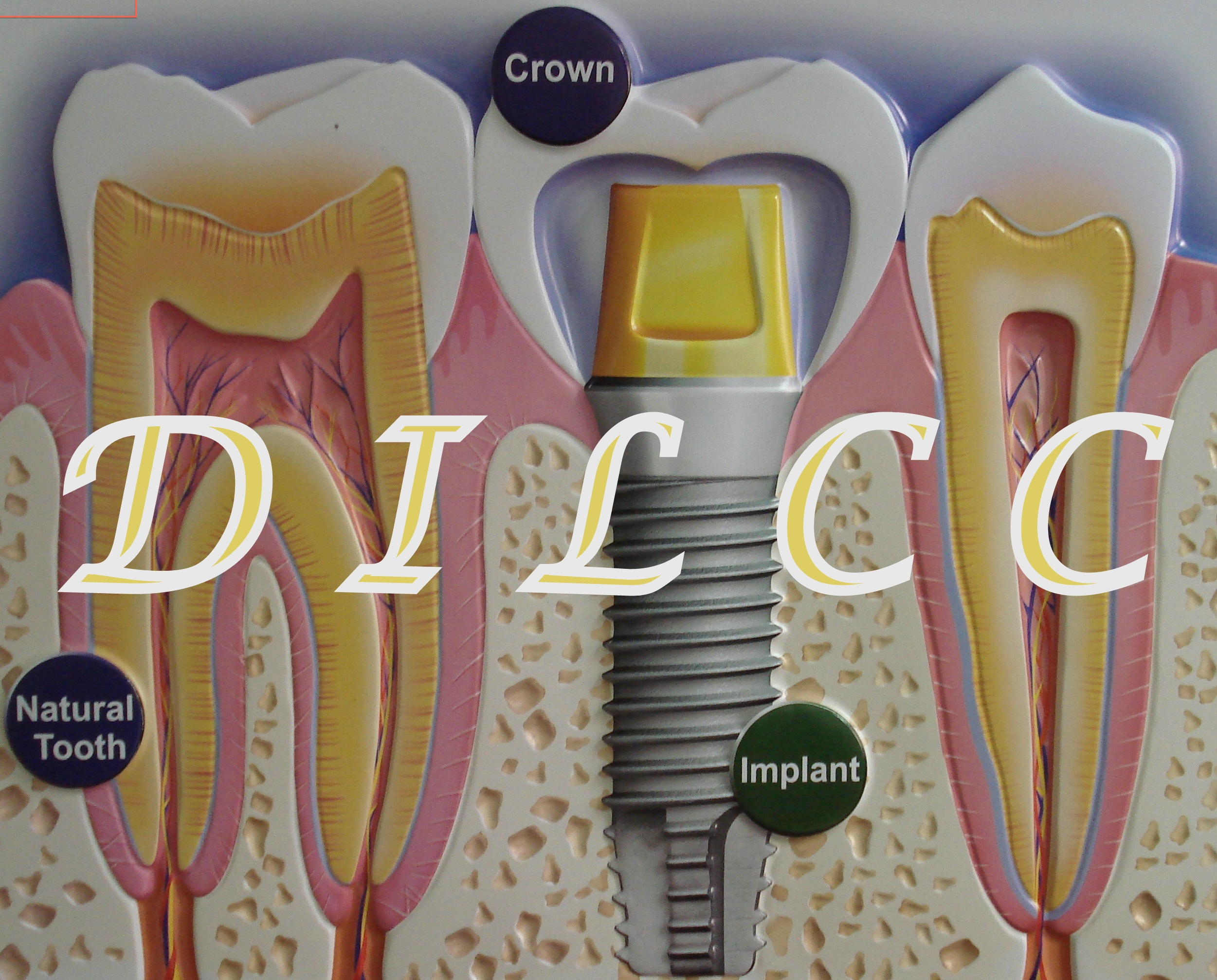 Dental Implant Laser Cosmetic Centre