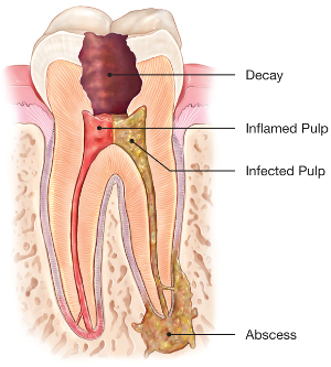 Root Canal Abcessed Tooth'