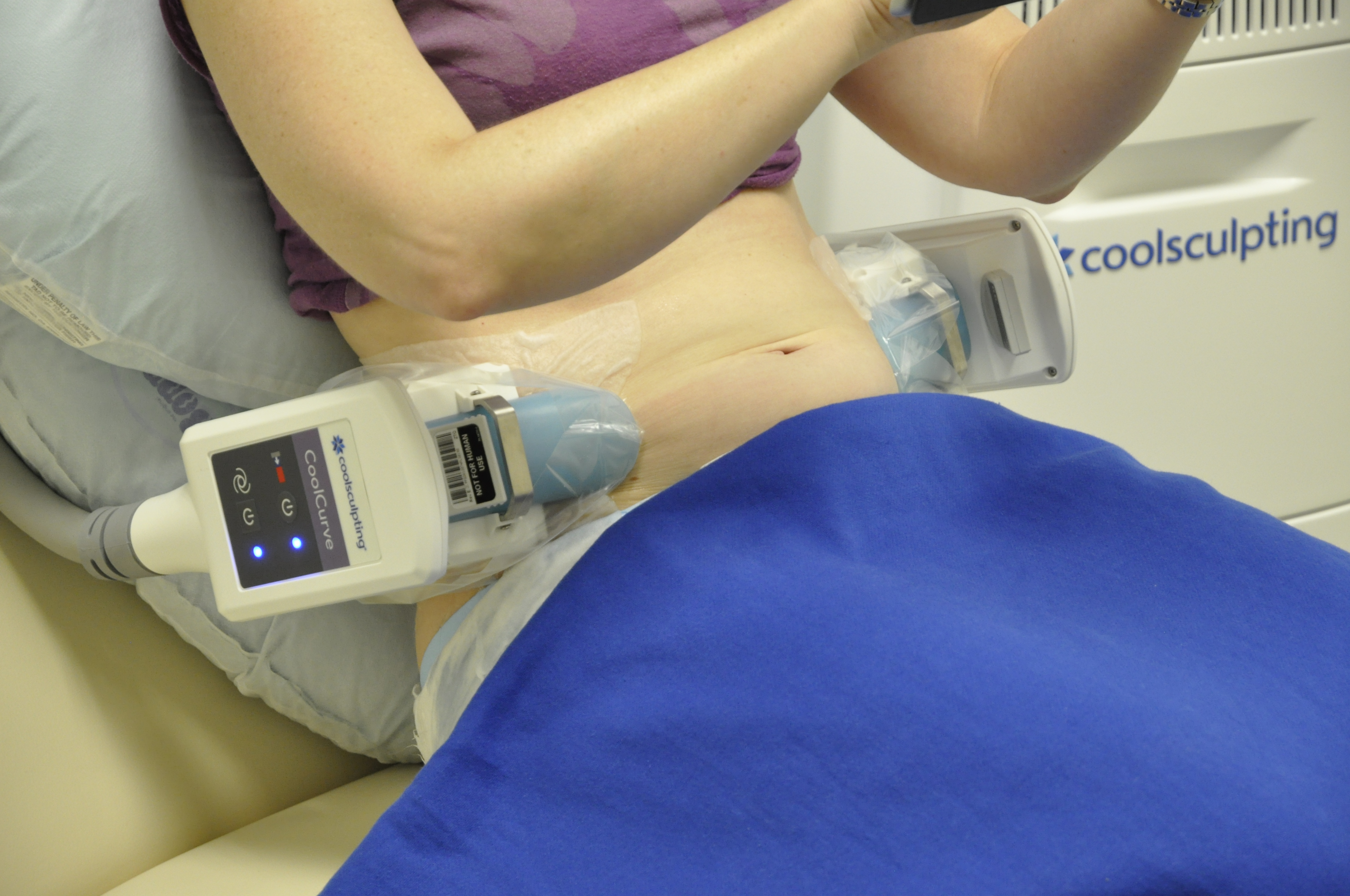 DualSculpting Treatment in Action'