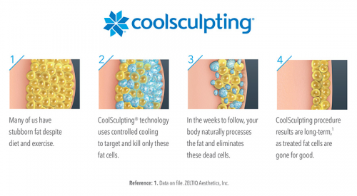 How CoolSculpting Works'