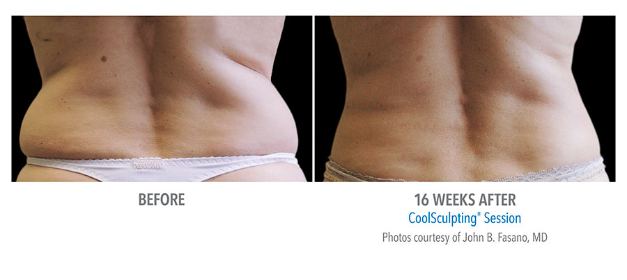 DualSculpting Before and After Results on Love Handles'