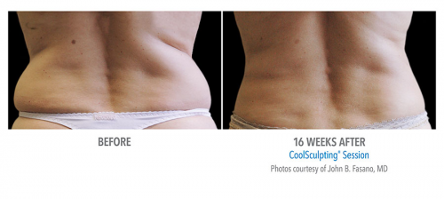 DualSculpting Before and After Results on Love Handles'