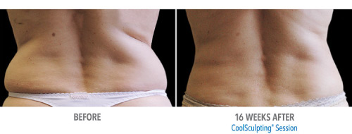 DualSculpting Before and After Results on Love Handles