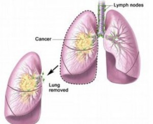 Lung Cancer Staging'