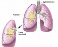 Lung Cancer Staging