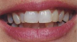 Porcelain Veneers Before'