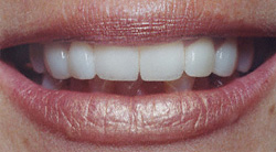 Porcelain Veneers After