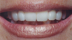 Porcelain Veneers After'