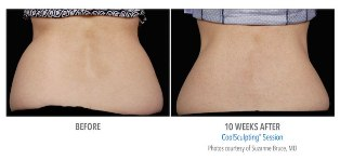 Beverly Hills CoolSculpting