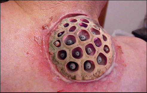 Trypophobia