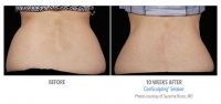 beverly hills coolsculpting