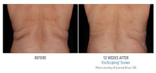 CoolSculpting in Beverly Hills'