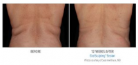 CoolSculpting in Beverly Hills