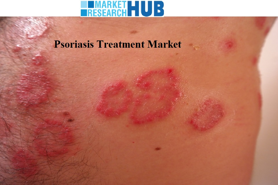 Psoriasis Treatment Market Precise Industry Analysis and Gro