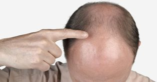 St. Louis Hair Transplant Mentor