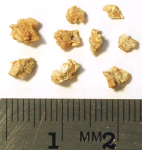 Kidney Stones'