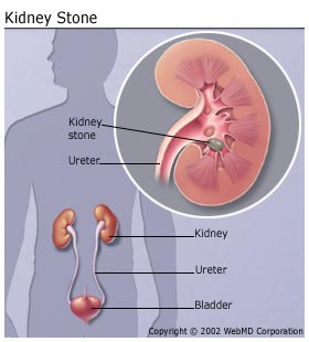 Kidney Stones Kelly Habbas'
