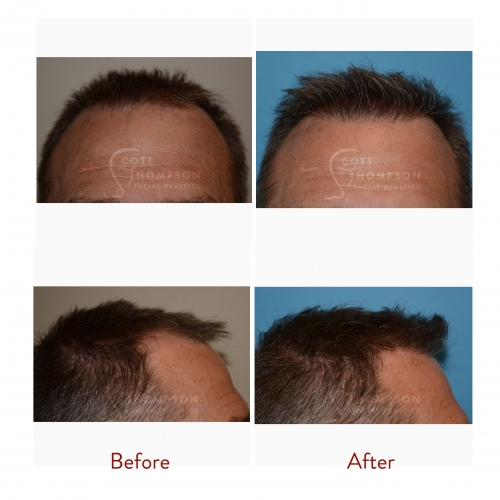 Hair Transplant Surgery Results from Dr. Scott Thompson'
