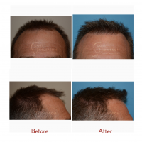 Hair Transplant Surgery Results from Dr. Scott Thompson