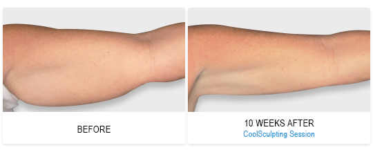 Before and After of CoolPetite Treatment