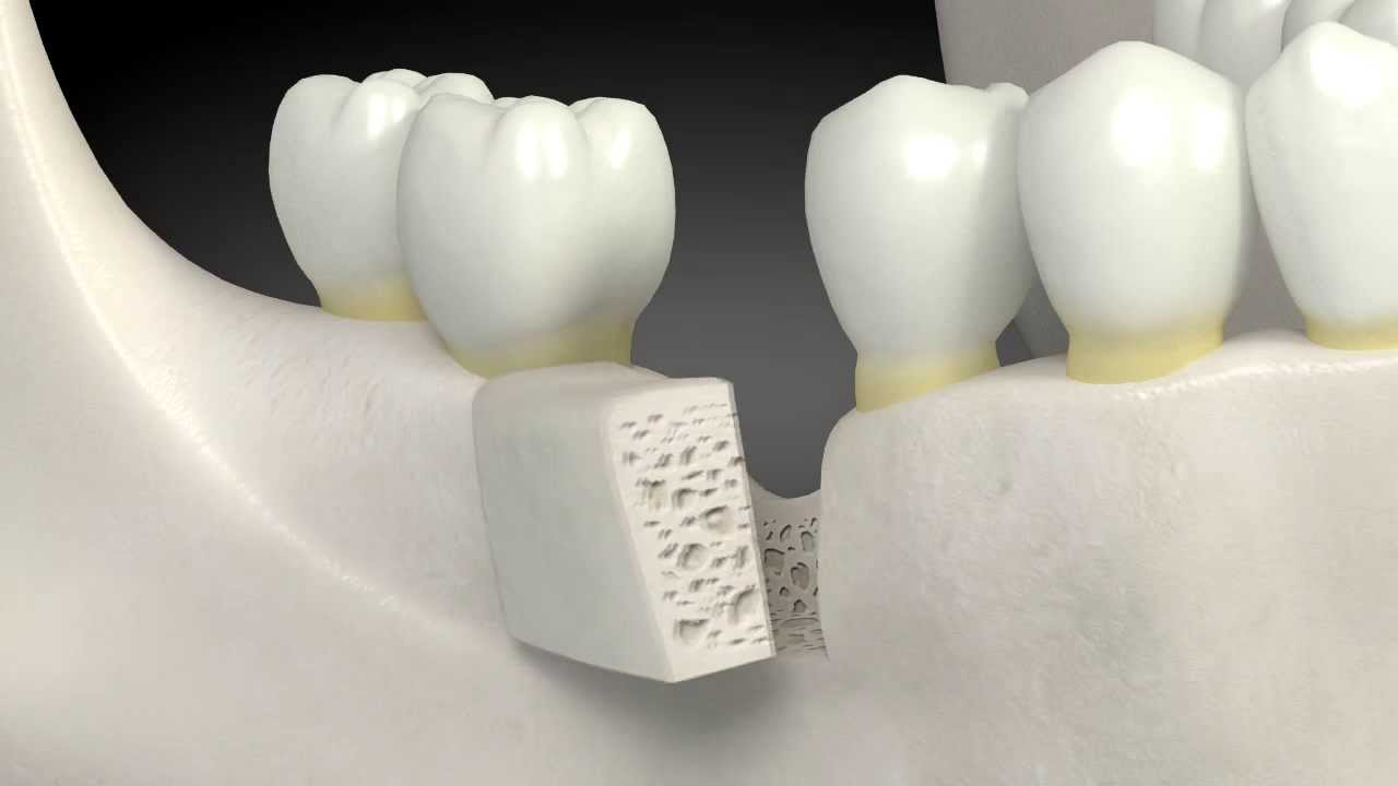 Bone Grafts Substitutes Market