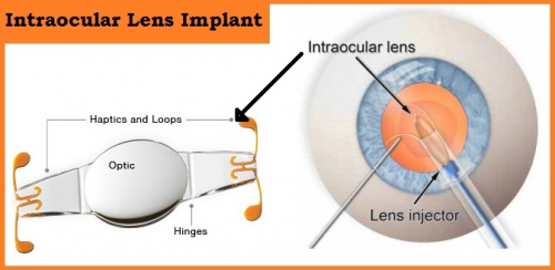 Intraocular Lens Market'
