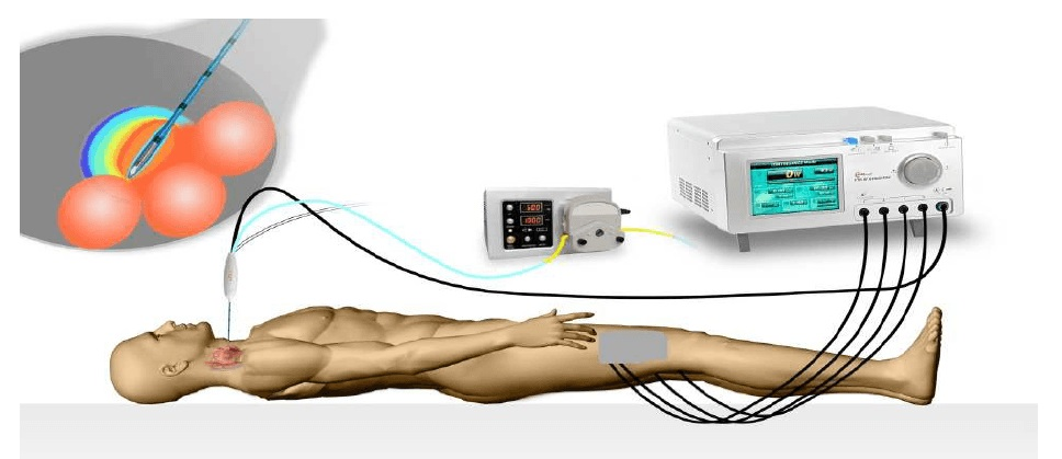 Radiofrequency Ablation Devices Market