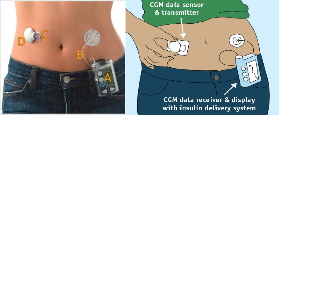 Global Continuous Glucose Monitoring Systems Market