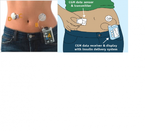 Global Continuous Glucose Monitoring Systems Market'