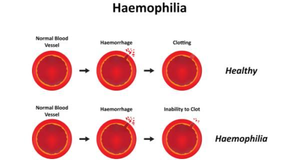 Hemophilia Treatment Market