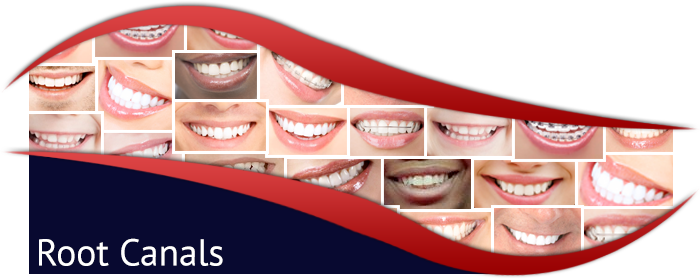 Root Canal Treatment'