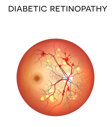 Diabetic Retinopathy'