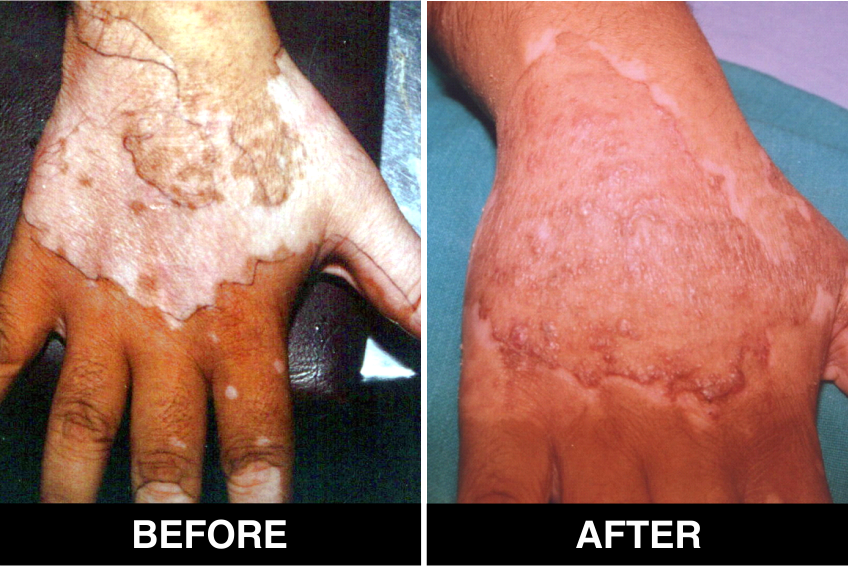 Vitiligo Tretment Services'