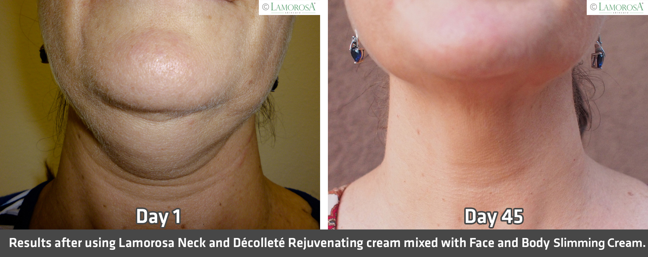 Before and After Neck Slimming