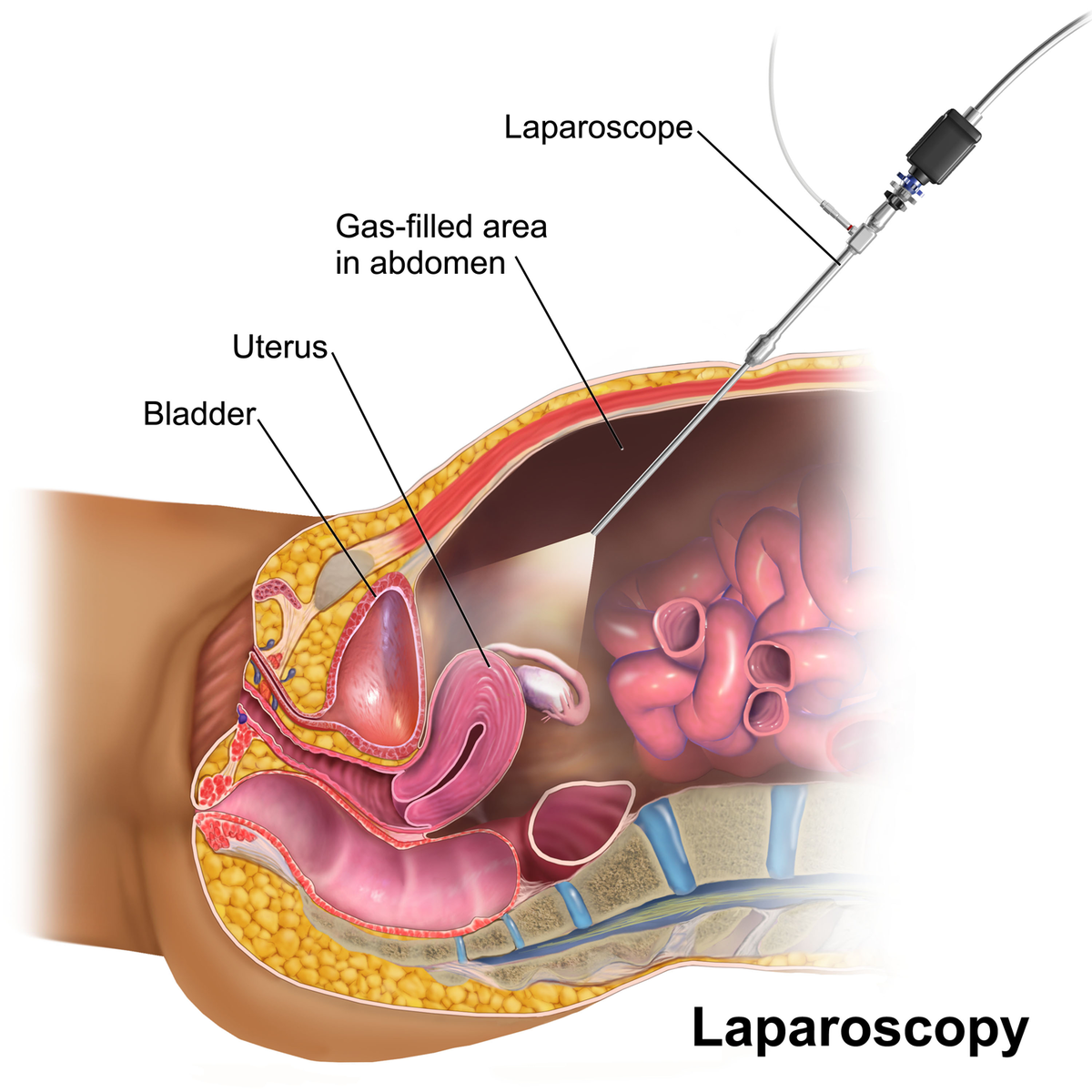Transvaginal Endoscopy Market  Global Opportunity : 2017-202