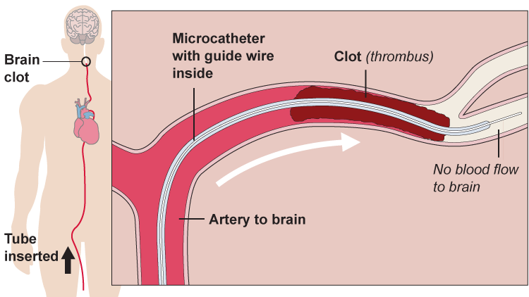 Neurovascular Stent Retrievers Market'