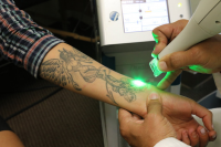 Tattoo Removal Market Expected to Reach $27,317 Million by 2