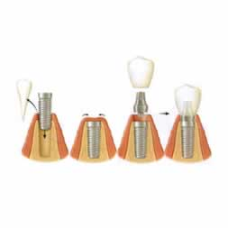 Dental Implants'