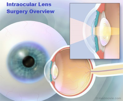 Intraocular Lens'