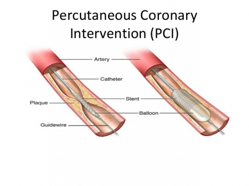 Complex Percutaneous Coronary Intervention Market'