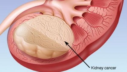 Europe Kidney Cancer Drugs Market : Opportunity Analysis 20