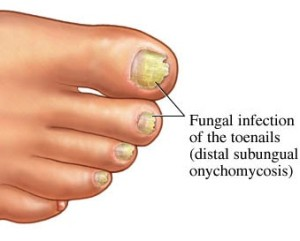 Dermatophytic Onychomycosis Market